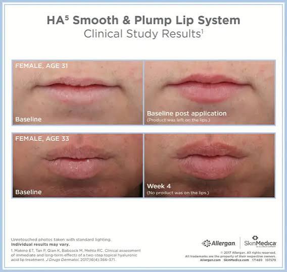 HA⁵® Smooth and Plump Lip System