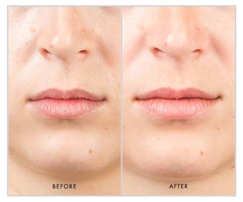 HA⁵® Smooth and Plump Lip System