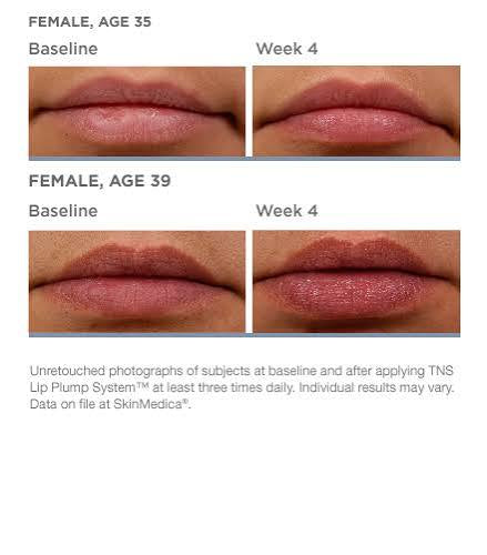 HA⁵® Smooth and Plump Lip System